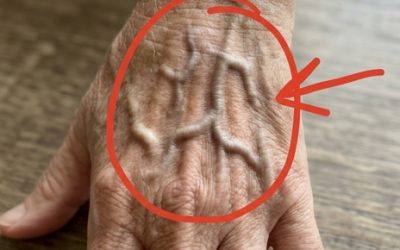 Si vos veines sont visibles, voici ce que cela signifie