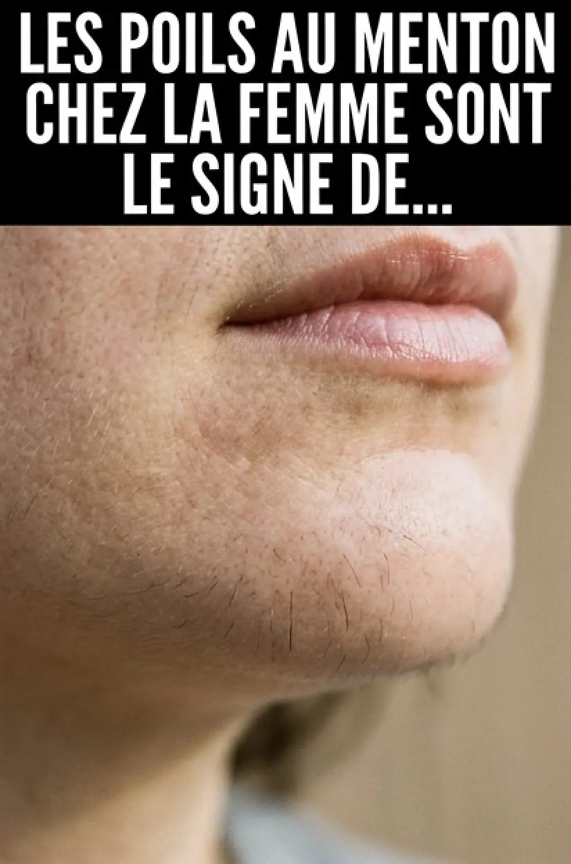 Les poils au menton d’une femme sont un signe de…