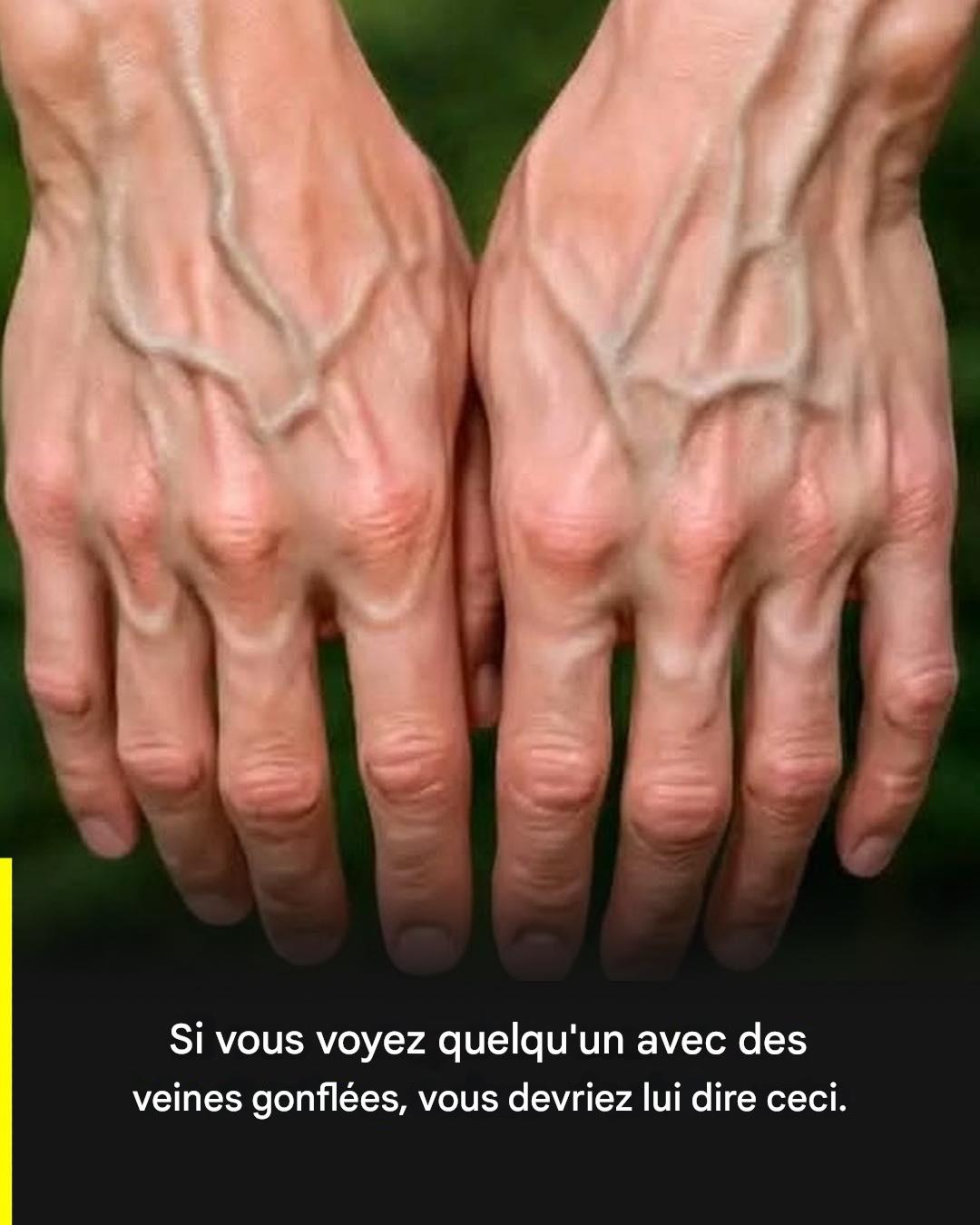 Si vos veines sont visibles, cela signifie que vous êtes… Voir plus