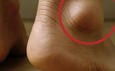Jambes enflées : quels sont les symptômes et les traitements ?