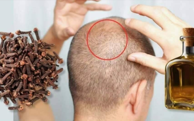 À 75 ans, les cheveux repoussent même sur les zones dégarnies ! Voici comment l’huile de clou de girofle peut stimuler la pousse des cheveux.