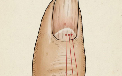 Si vous remarquez ces lignes sur vos ongles, vous devriez y prêter attention.