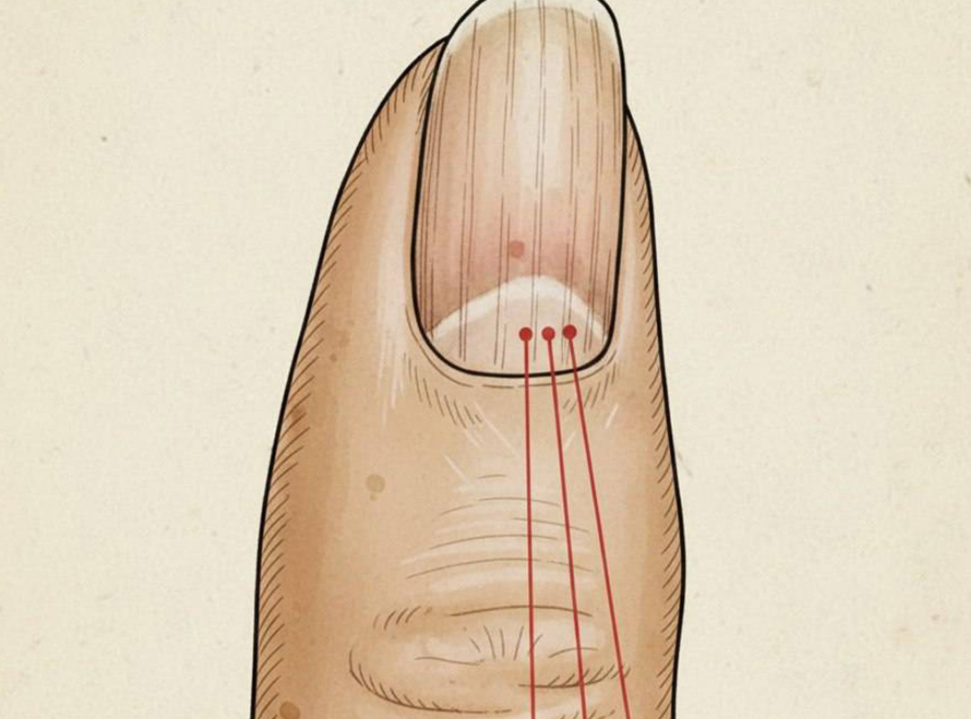 Si vous remarquez ces lignes sur vos ongles, vous devriez y prêter attention.