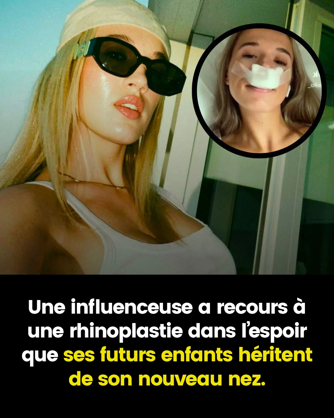 Une influenceuse affirme avoir subi une rhinoplastie dans l’idée que ses enfants puissent hériter de son nouveau nez